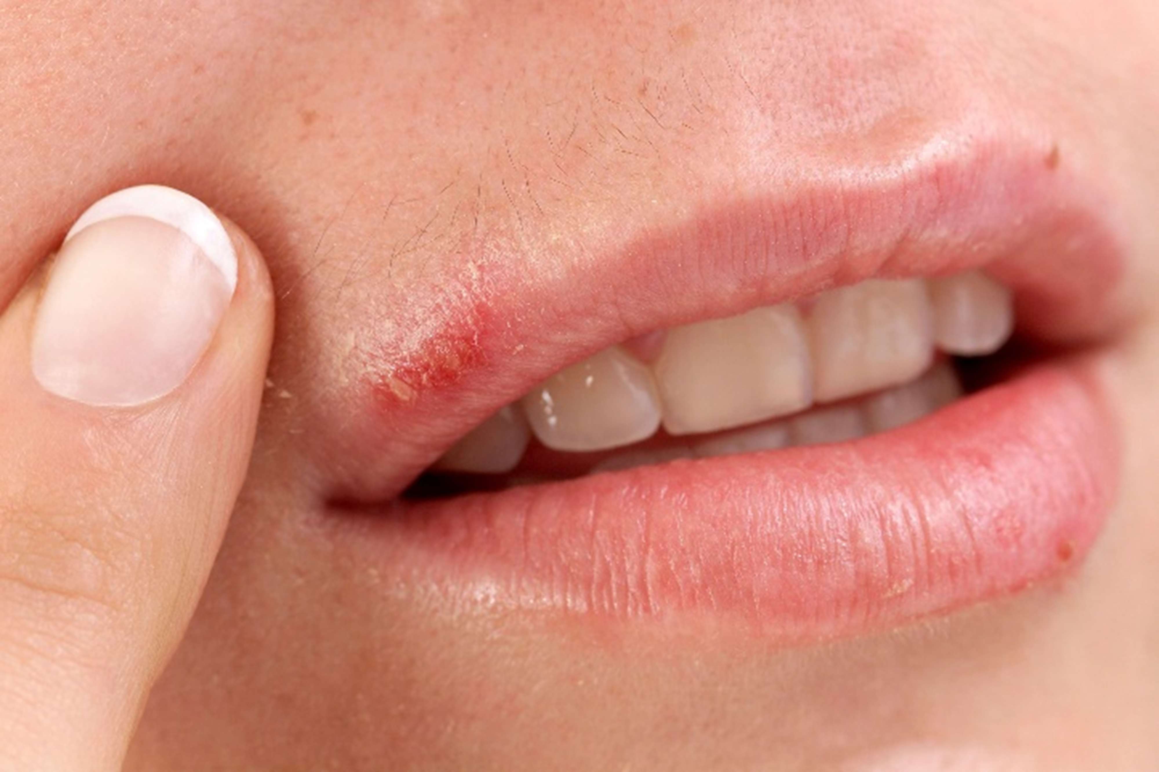 A close-up image of a person’s lips showing cold sore on the upper lip .