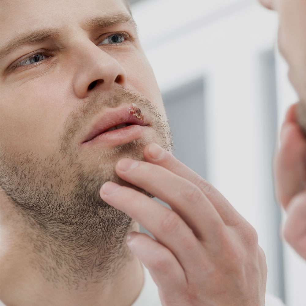 Foods to Avoid When You Have a Cold Sore Foods to Avoid When You Have a Cold Sore